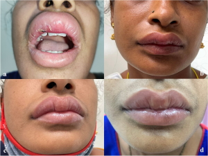 Mengenal Cheilitis Granulomatosa, Pembengkakan Bibir