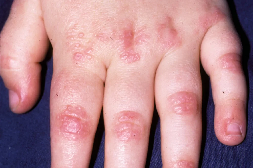 Dermatomiositis Juvenil, Penyakit Autoimun pada Usia Anak