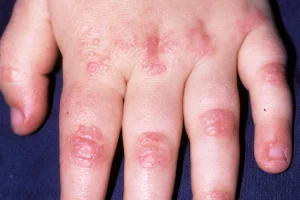 Dermatomiositis Juvenil, Penyakit Autoimun pada Usia Anak