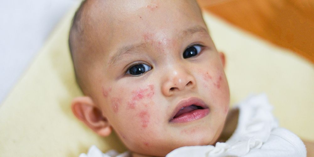 Mengenal Eritema Infeksiosa, Penyakit “Pipi Merah” pada Anak-Anak
