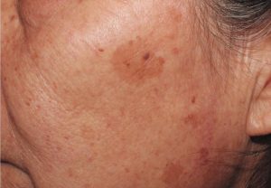 Mengenal Keratosis Lichenoid Lebih Dalam Kondisi Kulit Langka