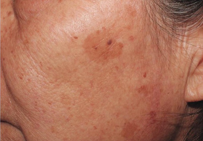 Mengenal Keratosis Lichenoid Lebih Dalam Kondisi Kulit Langka