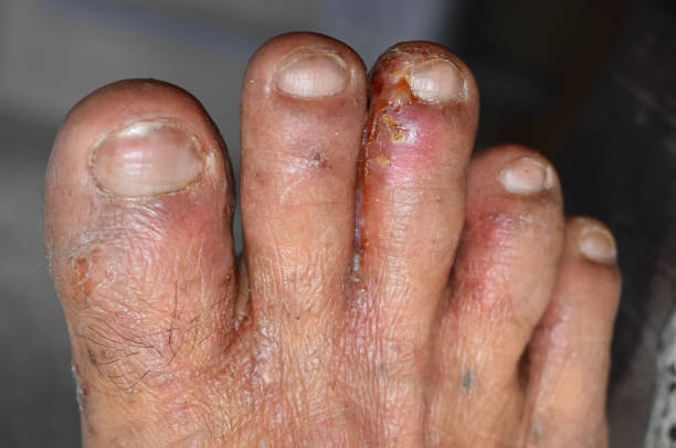 Mengenal Kurap pada Kaki, Penyebab Gejala dan Pengobatannya