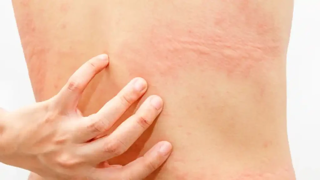 Notalgia Paresthetica, Menyebabkan Rasa Gatal di Area Punggung