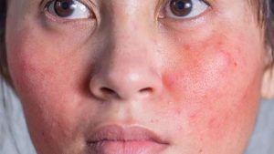 Makanan yang Harus Dihindari agar Skin Barrier Tetap Sehat