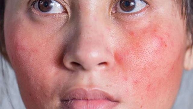 Makanan yang Harus Dihindari agar Skin Barrier Tetap Sehat