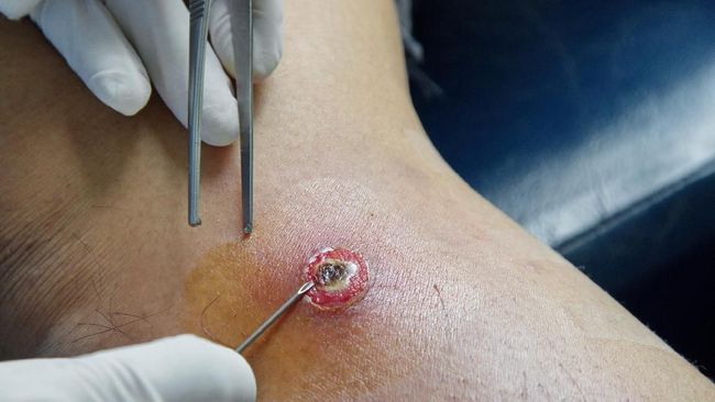 Cara Rawat Luka Bekas Bisul agar Cepat Sembuh Tanpa Noda