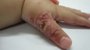 Gejala Awal Herpetic Whitlow yang Sering Tidak Disadari