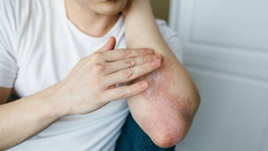 Infeksi Jamur di Kulit Tangan, Solusi untuk Kulit yang Mudah Iritasi