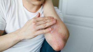 Infeksi Jamur di Kulit Tangan, Solusi untuk Kulit yang Mudah Iritasi