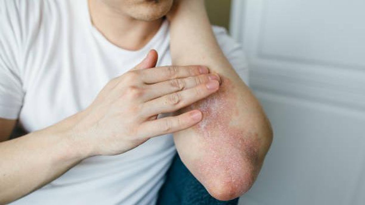 Infeksi Jamur di Kulit Tangan, Solusi untuk Kulit yang Mudah Iritasi