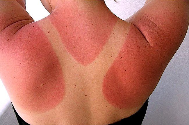 Kerusakan Kulit Akibat Sunburn, Ini Pengobatannya Dengan Cara Alami