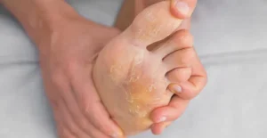 Kesalahan Umum Saat Obati Kutu Air yang Jadi Infeksi Parah
