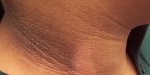 Kulit Hitam pada Lipatan Tubuh Secara Perlahan, Ini Penyebabnya