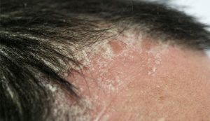 Psoriasis, Kronis yang Bisa Muncul pada Anak dan Orang Dewasa