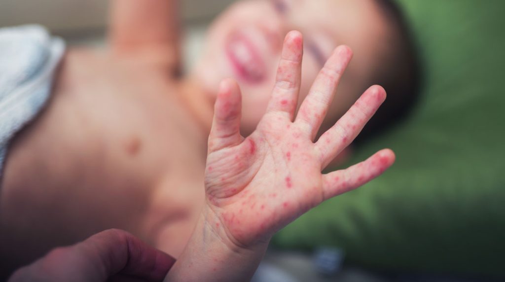 Rubella Ringan Tetap Berbahaya? Kenali Komplikasi yang Bisa Terjadi
