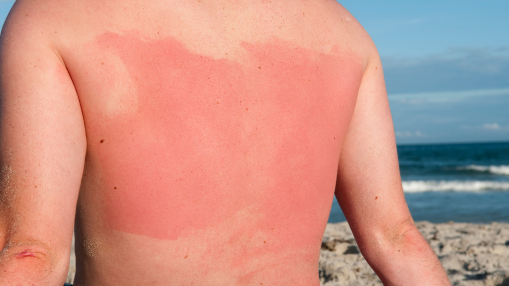 Sunburn Parah Bisa Sebabkan Kulit Rusak, Ini Cara Melindungi Diri