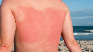 Sunburn Parah Bisa Sebabkan Kulit Rusak, Ini Cara Melindungi Diri