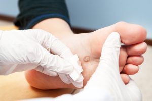 Cara Atasi Kutil Membandel di Tangan dan Kaki tanpa Rasa Sakit