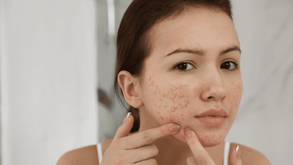Cara Hilangkan Jerawat Dipipi dan Dahi dengan Cara Sederhana