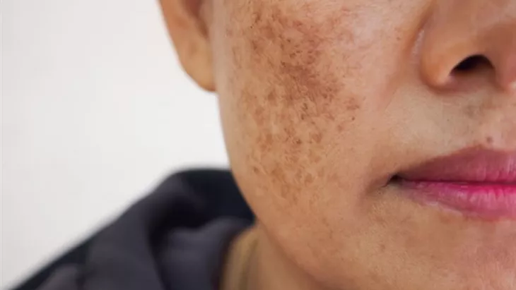Faktor Hormonal Penyebab Melasma, Cara Jaga Kulit Tetap Sehat
