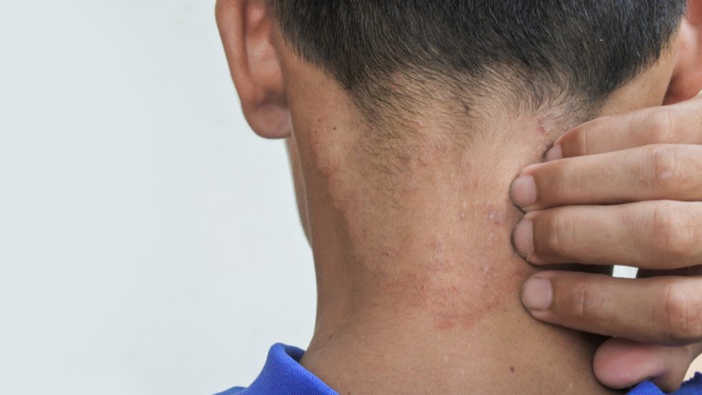 Gejala Awal Acanthosis Nigricans yang Sering Diabaikan