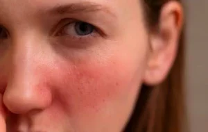 Perbedaan Kulit Sensitif dan Rosacea buat Wajah Mudah Merah